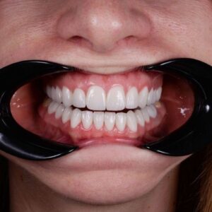 إعادة تأهيل الفم بالكامل